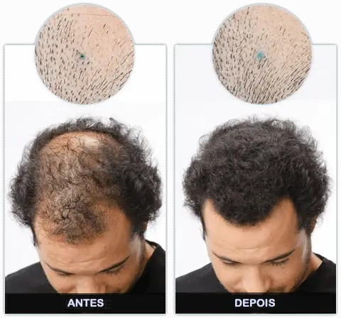 Kirkilandi Hair Regrowth Antes e Depois