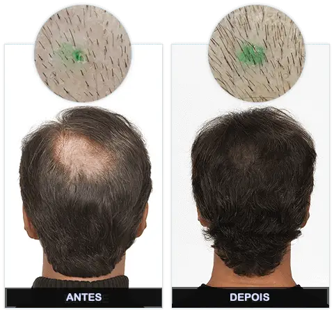 Lume Hair Antes e Depois