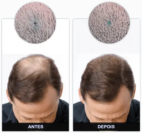 Lume Hair Antes e Depois