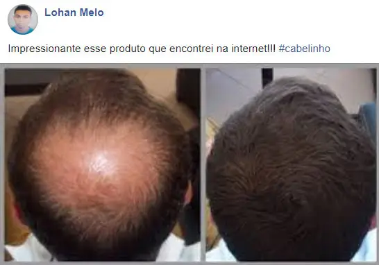 Grow Hair Tratamento antes e depois - Lohan Melo