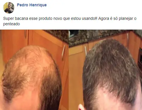 Hair Life Caps antes e depois - Pedro Henrique
